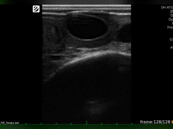 Lutein cyst (diagnostic image taken using iScan 3)